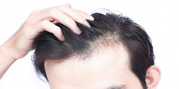 تخلخل مو چیست