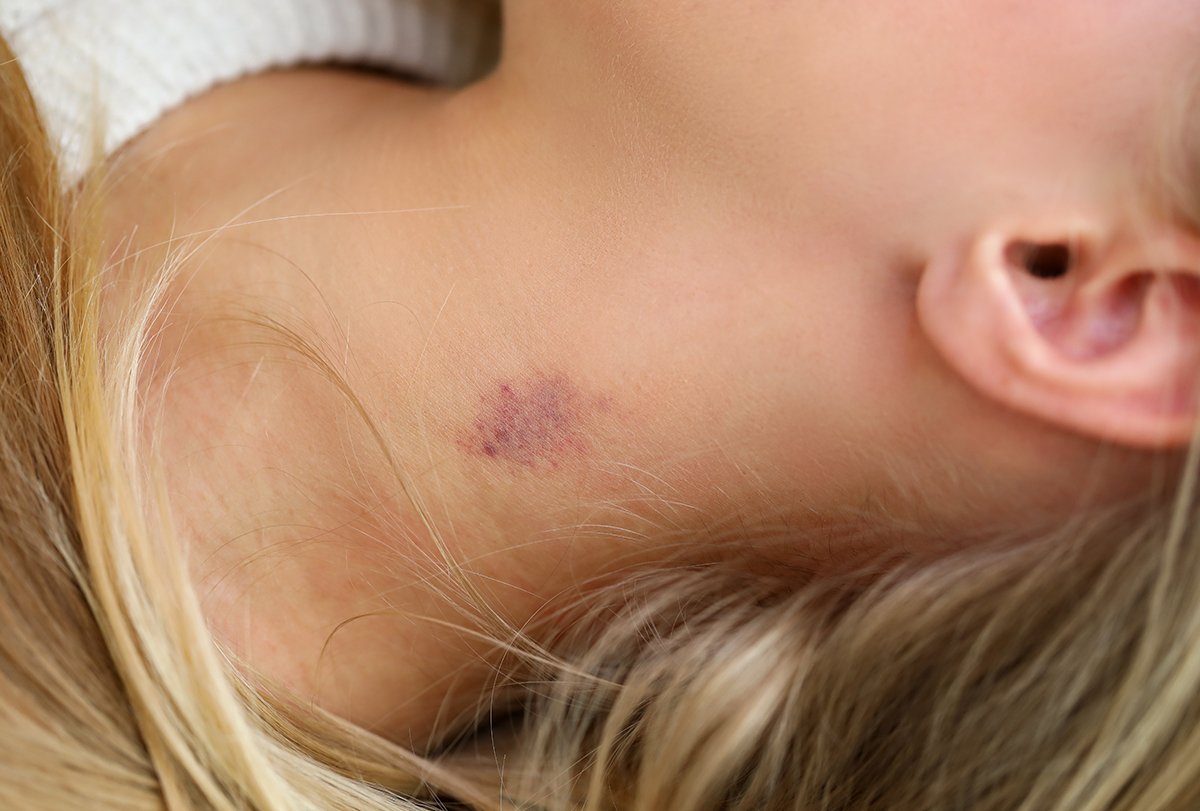 راه های درمان نیش عشق