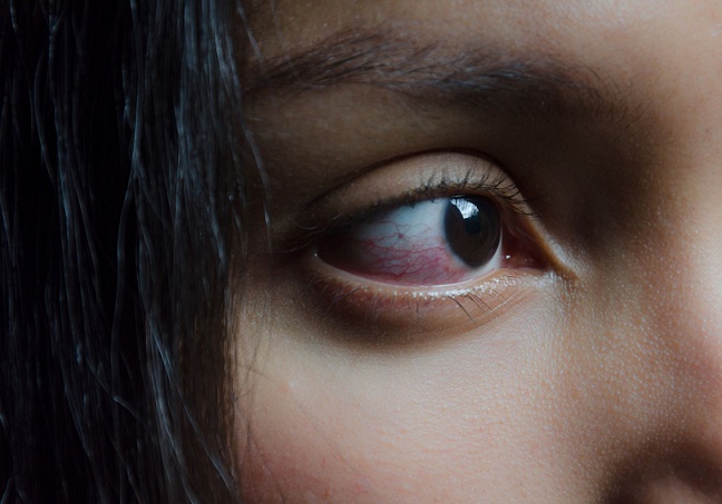 آرتریت پسوریاتیک چگونه روی چشم ها تأثیر می گذارد؟